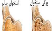 پوکی استخوان درمان پذیر است